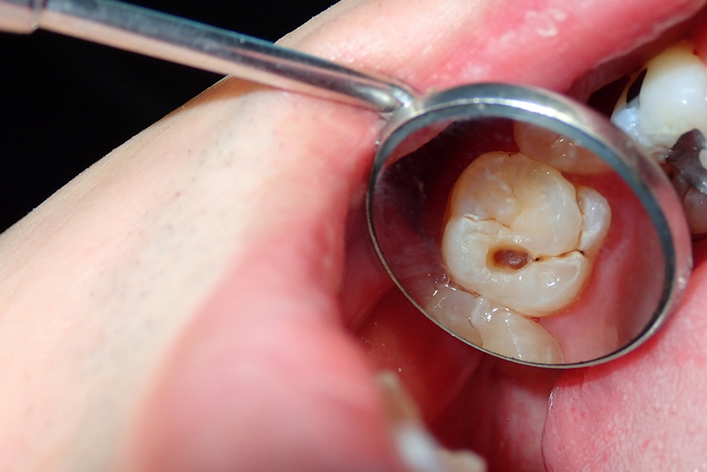 不良補綴物の再製