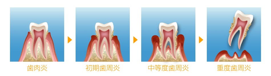 むし歯の進行度