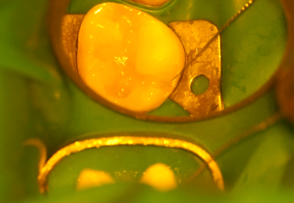 ダイレクトボンディング