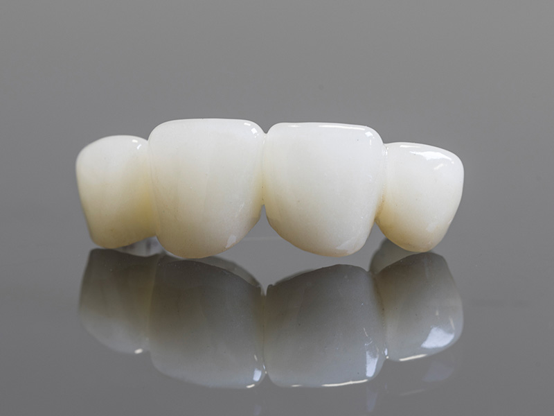 ブリッジ（義歯）