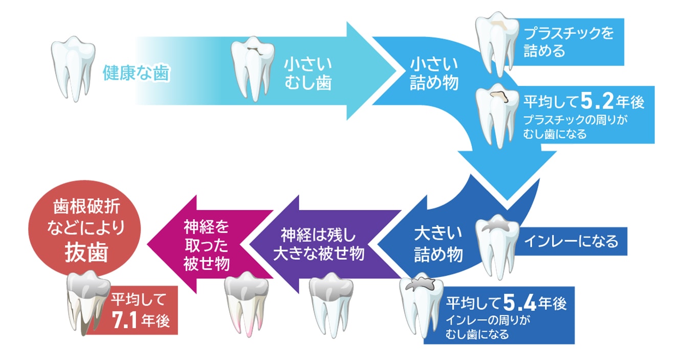 健康的な歯が抜歯されるまでの流れ　健康な歯→小さな虫歯→小さい詰め物（プラスチック）→平均して5.2年後にプラスチックの周りが虫歯になる。→大きい詰め物（インレー）→平均して5.4年後にインレーの周りが虫歯になる→神経は残し大きな被せもの→神経を取った被せもの→平均して7.1年後、歯根破俺折等により抜歯